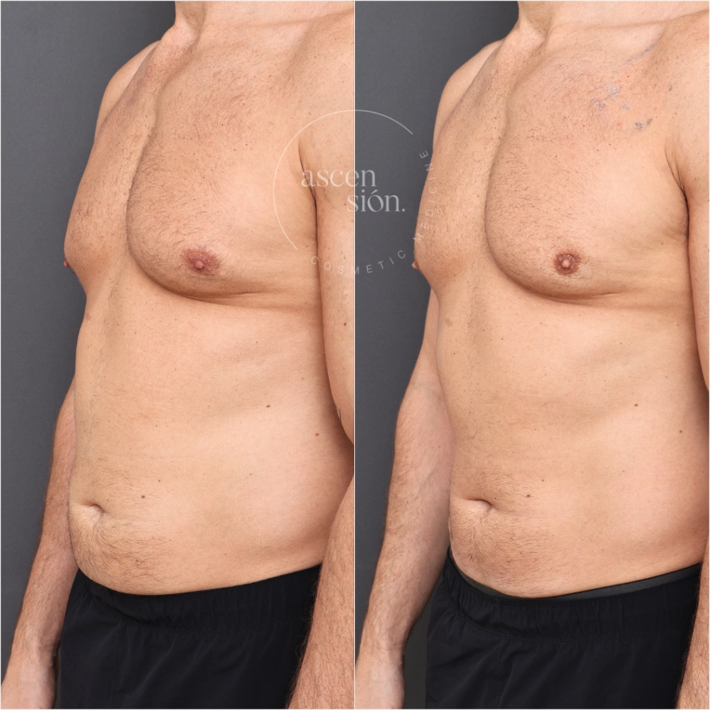 Choose the Right Body Contour Clinic and Treatment: 3 Things That Matter Most 2 Before and after male torso results from body contour clinic and treatments showing reduced fat and improved chest contour.