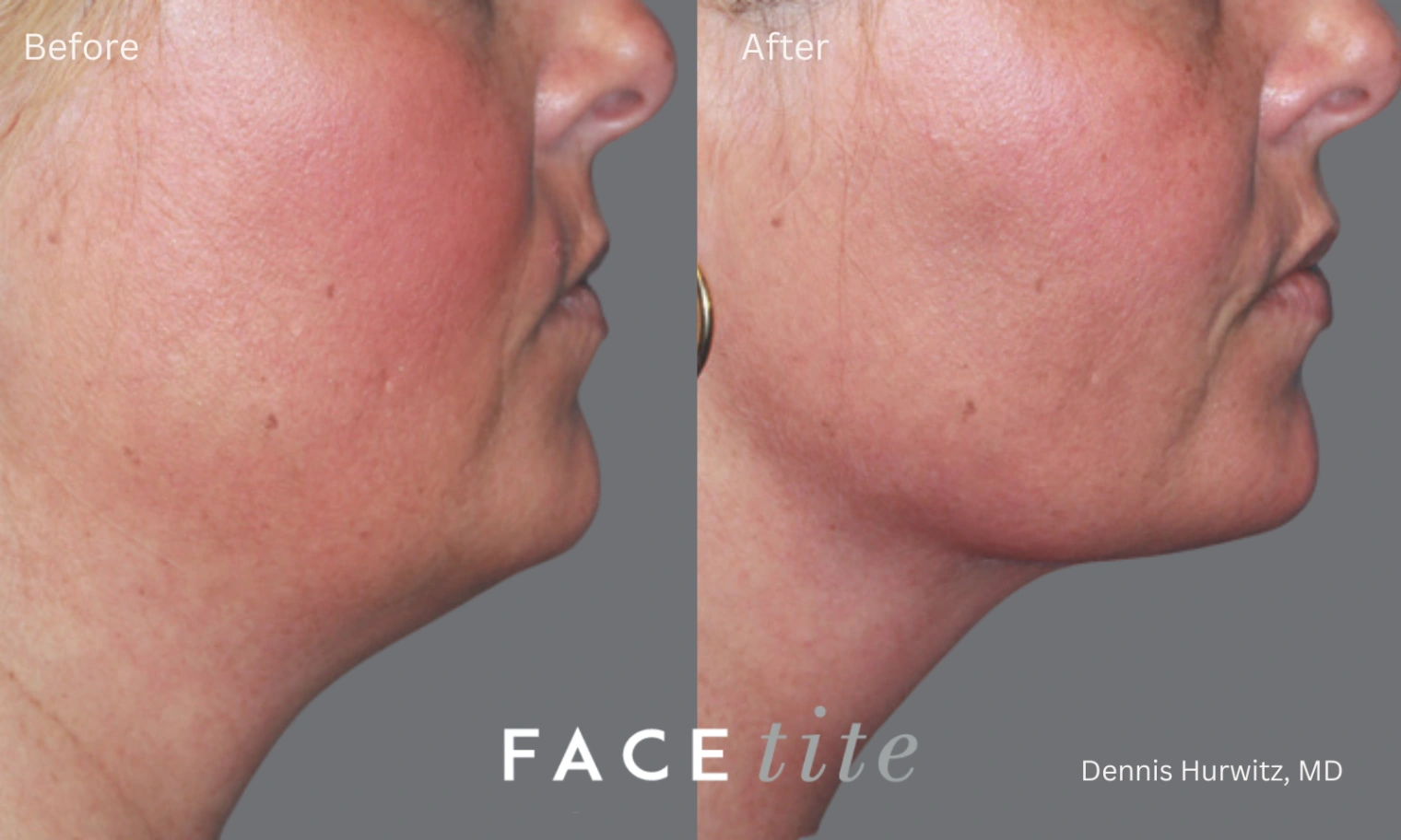 Side profile images before and after a FaceTite procedure showing the jawline area