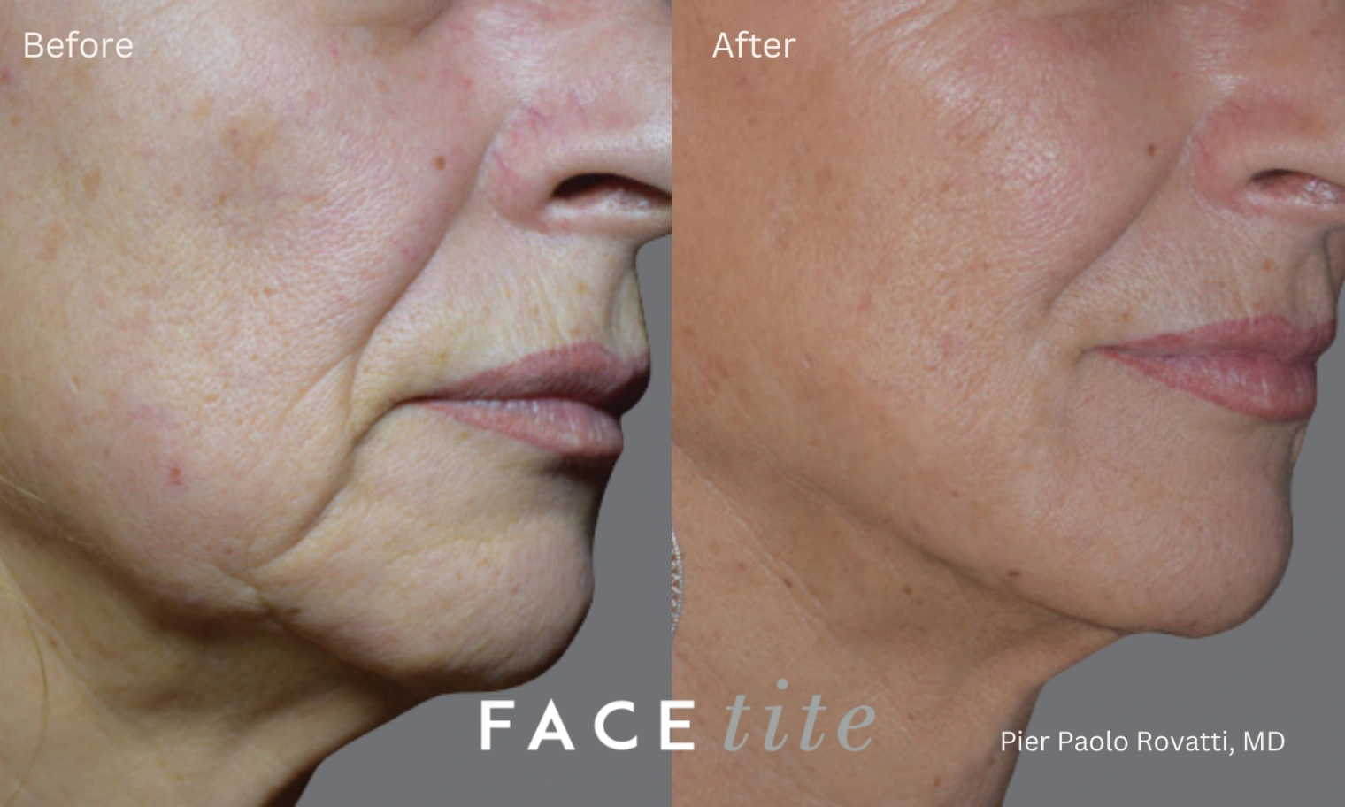 Close-up facial images before and after a FaceTite procedure at a documented stage of treatment.