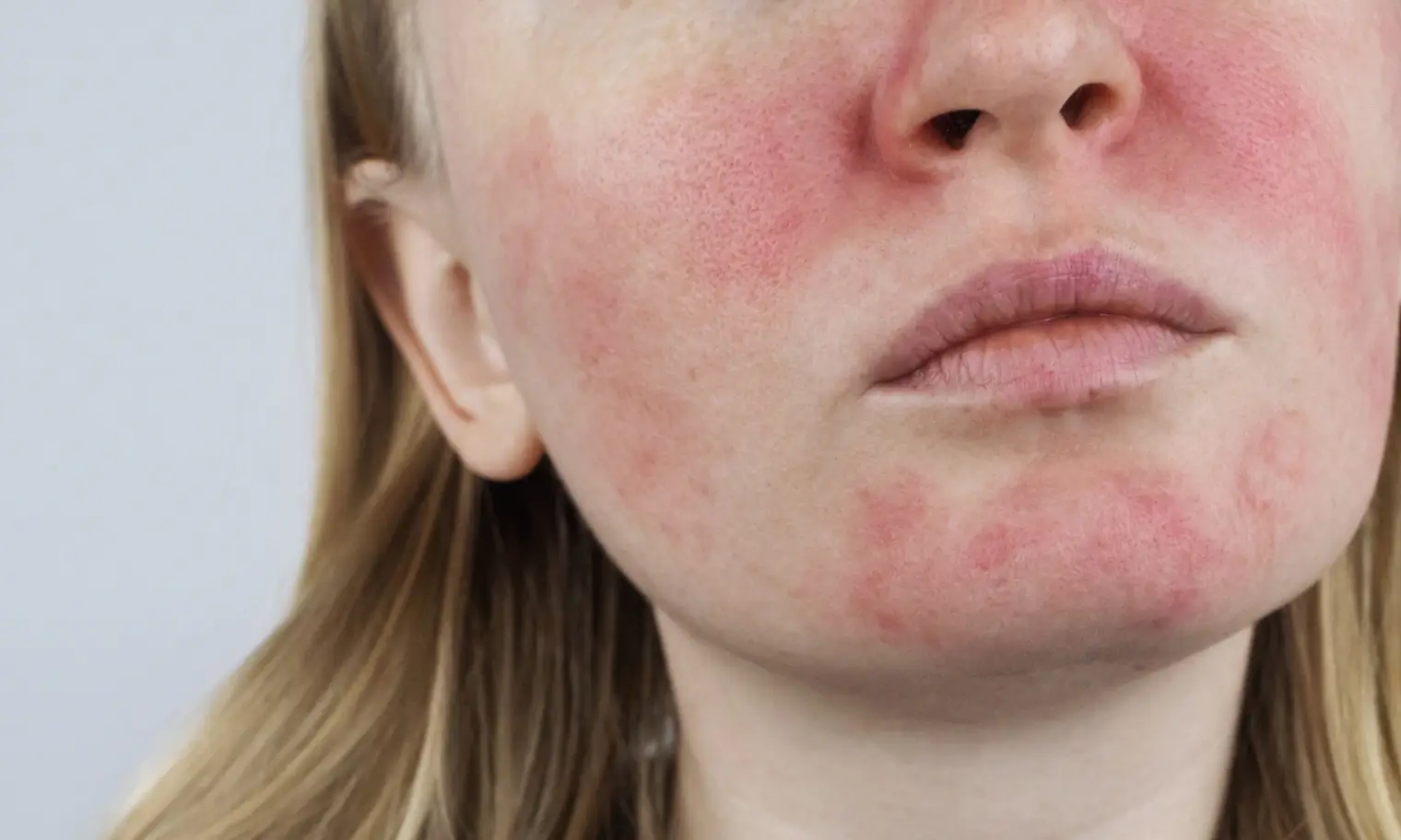 6 Vascular Concerns That Can Look Like Redness 3 Facial redness shown for vascular concerns education