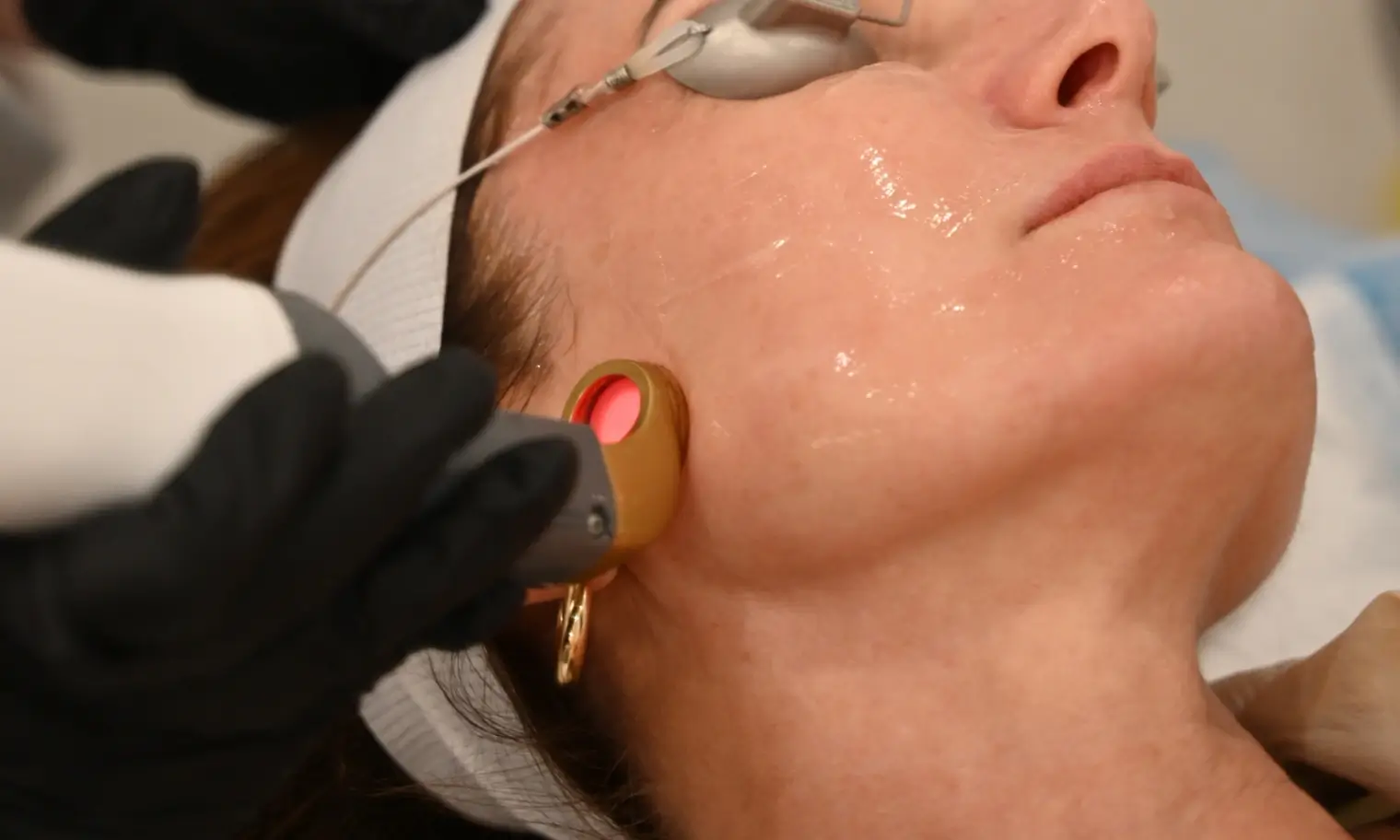 6 Vascular Concerns That Can Look Like Redness 4 Laser device shown in a vascular concerns care setting