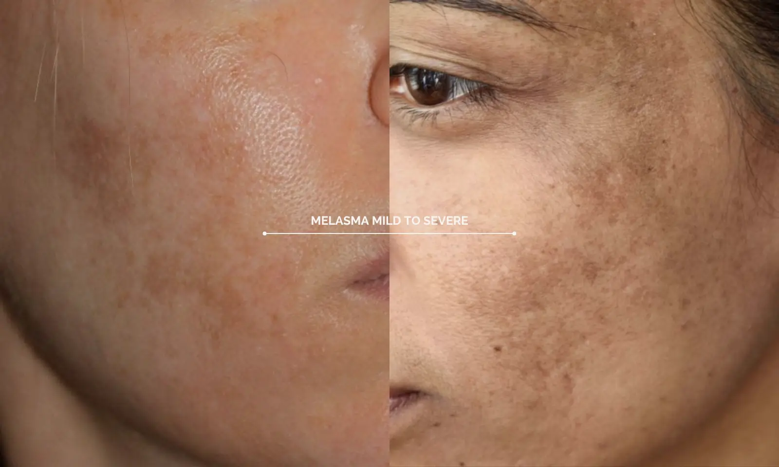 Close-up of facial pigmentation for melasma management education